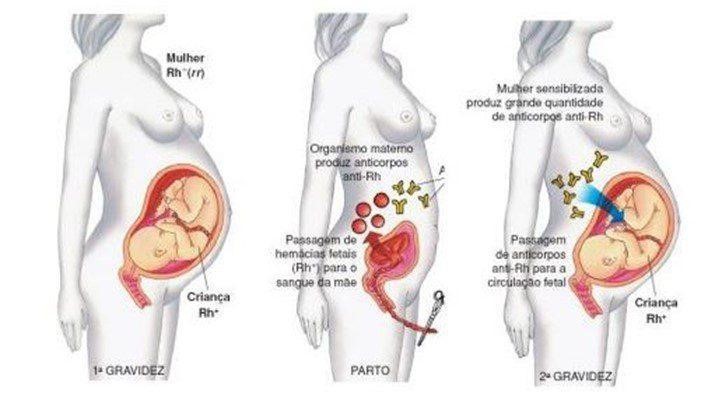 eritroblastose fetal